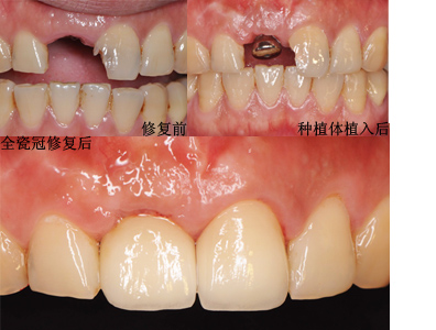 困扰一个月的牙疼问题解决了 上颌根管治疗后桩核冠修复一例